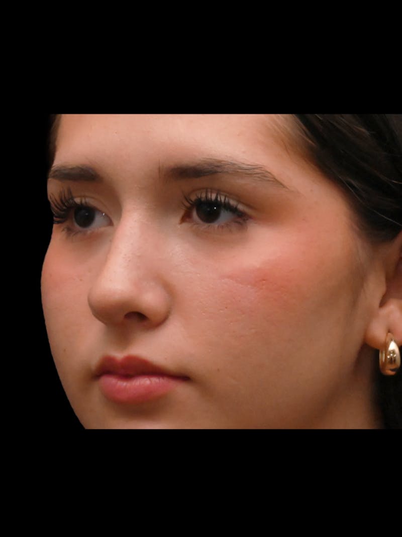 Rhinoplasty Before & After Gallery - Patient 257976 - Image 4