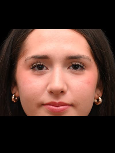 Rhinoplasty Before & After Gallery - Patient 257976 - Image 2