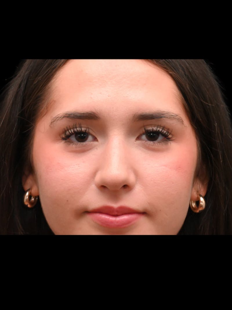 Rhinoplasty Before & After Gallery - Patient 257976 - Image 2