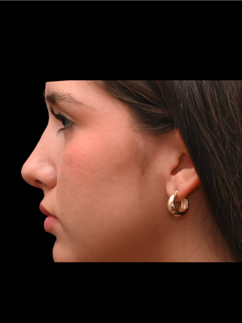 Rhinoplasty Before & After Gallery - Patient 257976 - Image 6