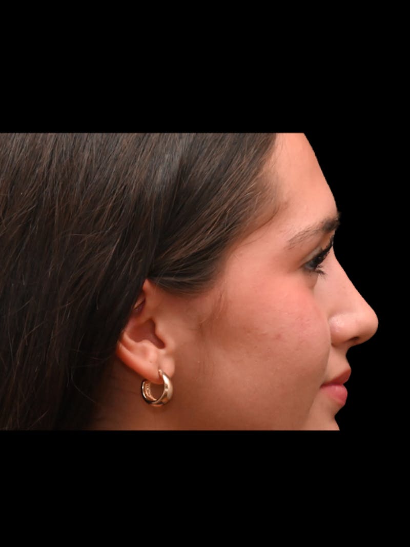 Rhinoplasty Before & After Gallery - Patient 257976 - Image 10