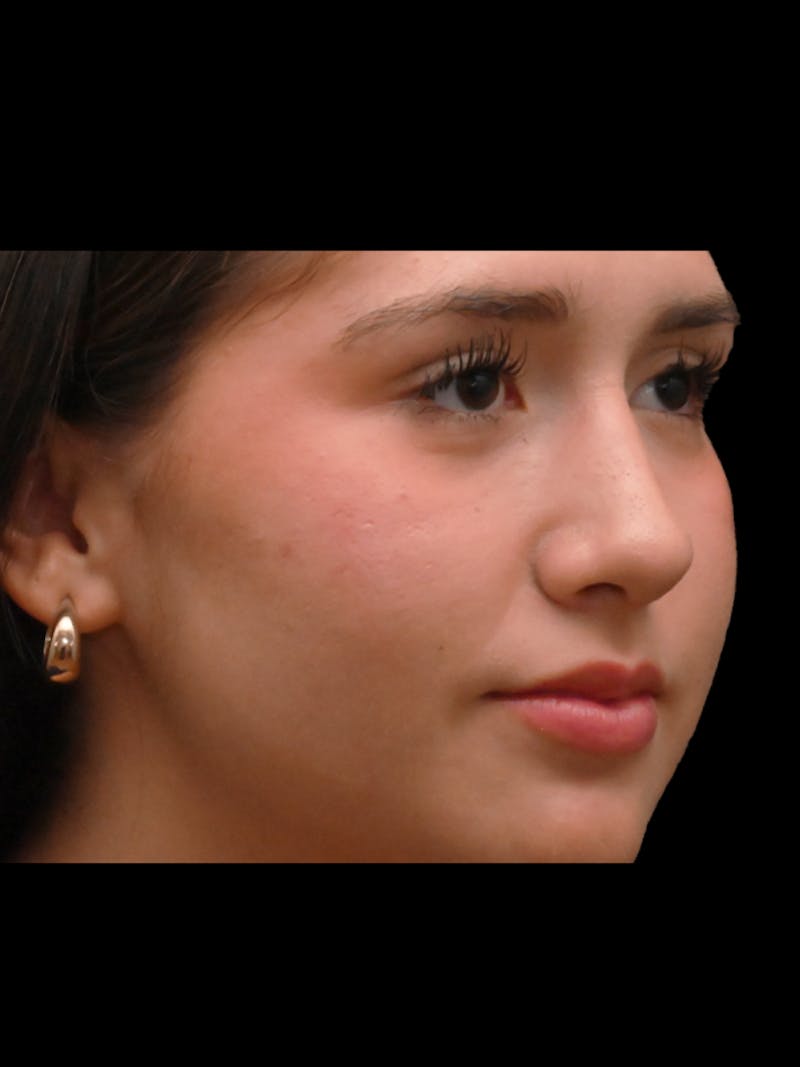 Rhinoplasty Before & After Gallery - Patient 257976 - Image 8