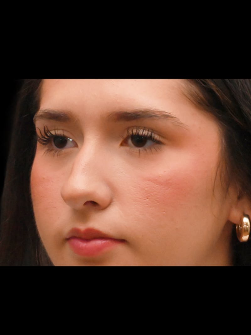 Rhinoplasty Before & After Gallery - Patient 257976 - Image 3