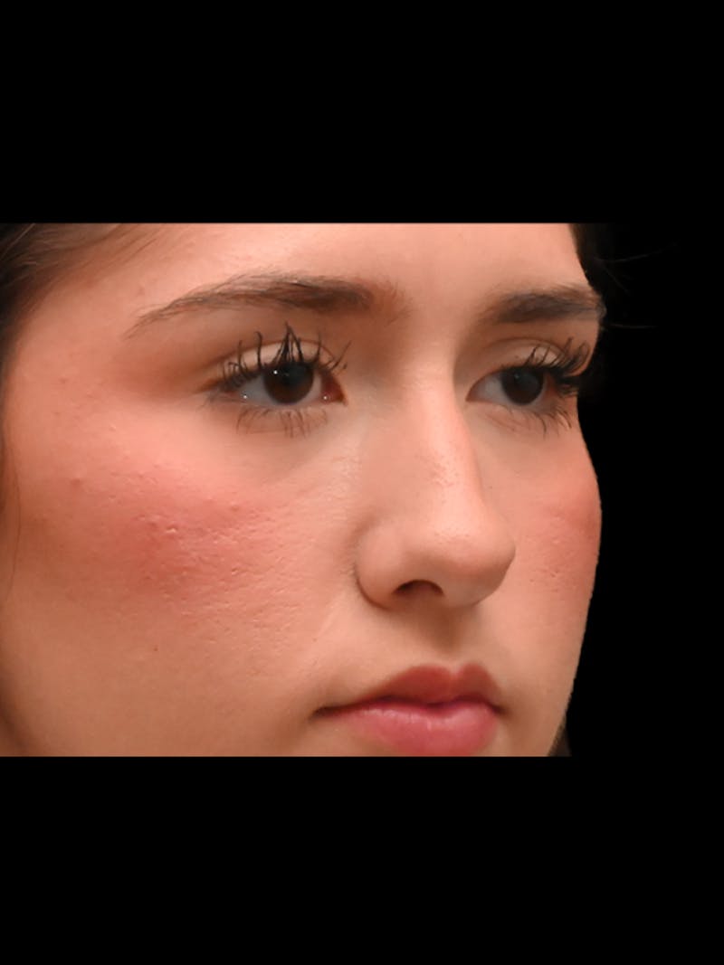 Rhinoplasty Before & After Gallery - Patient 257976 - Image 7
