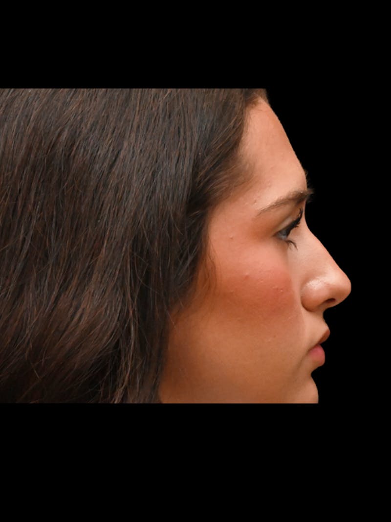 Rhinoplasty Before & After Gallery - Patient 257976 - Image 9