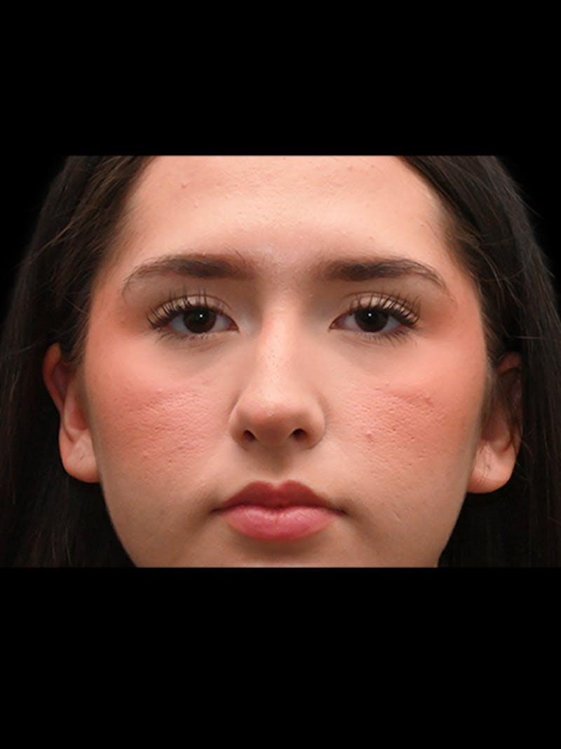 Rhinoplasty Before & After Gallery - Patient 257976 - Image 1