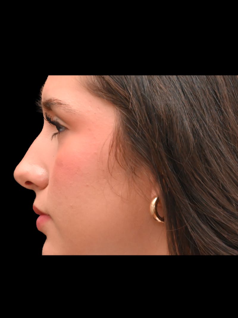 Rhinoplasty Before & After Gallery - Patient 257976 - Image 5