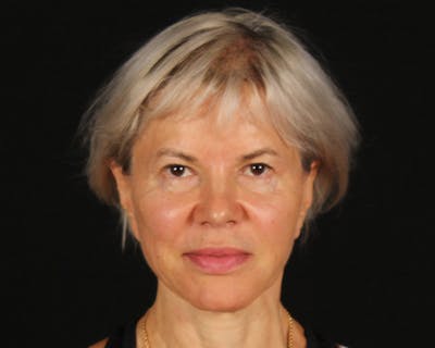 Face & Neck Lift Before & After Gallery - Patient 212796 - Image 1
