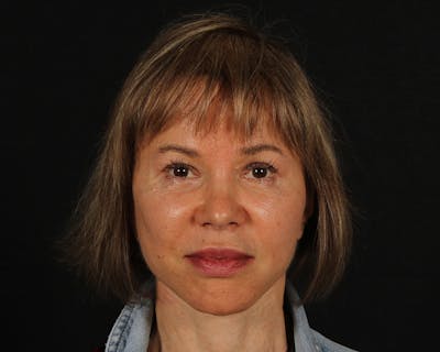 Face & Neck Lift Before & After Gallery - Patient 212796 - Image 2