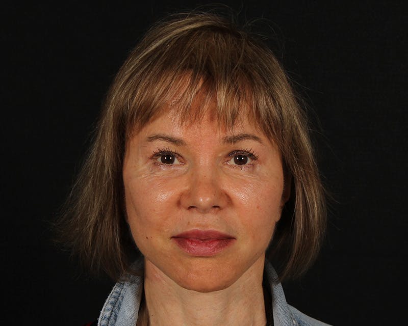 Face & Neck Lift Before & After Gallery - Patient 212796 - Image 2