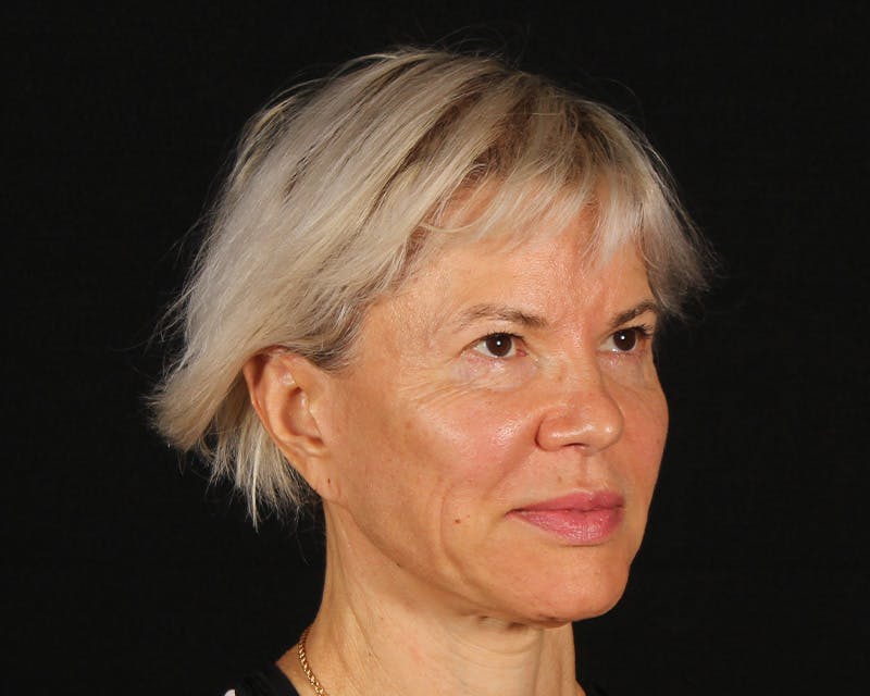 Face & Neck Lift Before & After Gallery - Patient 212796 - Image 3