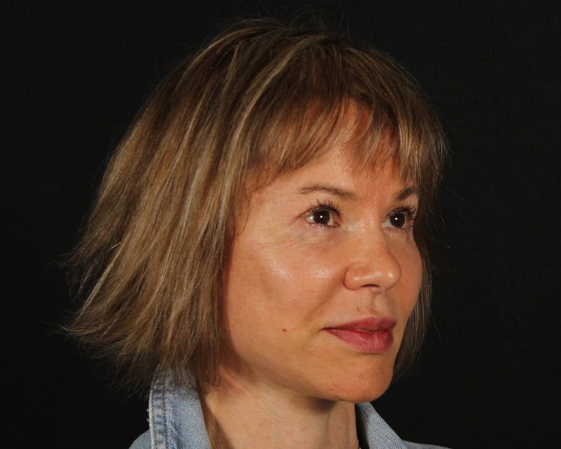 Face & Neck Lift Before & After Gallery - Patient 212796 - Image 4