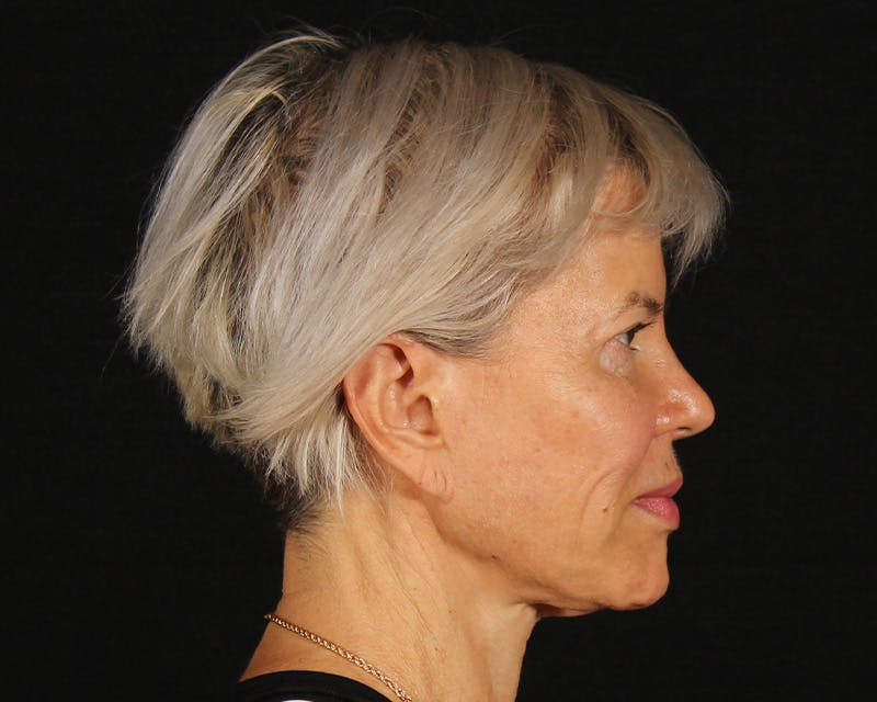 Face & Neck Lift Before & After Gallery - Patient 212796 - Image 5