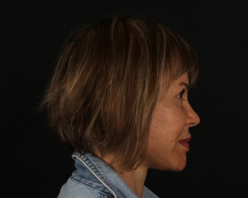 Face & Neck Lift Before & After Gallery - Patient 212796 - Image 6