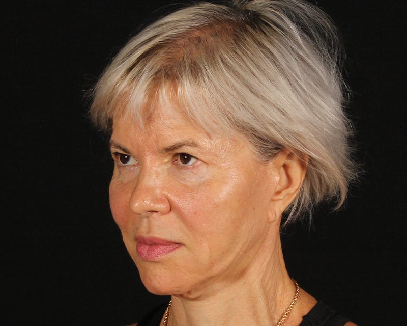 Face & Neck Lift Before & After Gallery - Patient 212796 - Image 7