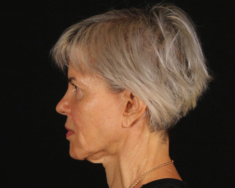 Face & Neck Lift Before & After Gallery - Patient 212796 - Image 9