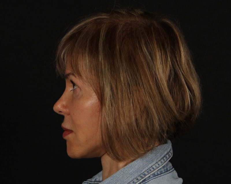 Face & Neck Lift Before & After Gallery - Patient 212796 - Image 10