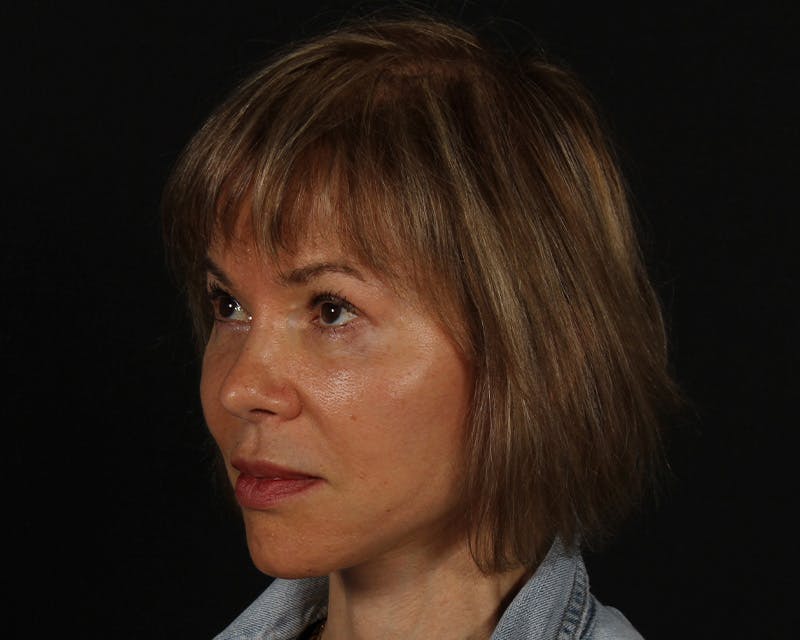 Face & Neck Lift Before & After Gallery - Patient 212796 - Image 8