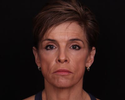 Face & Neck Lift Before & After Gallery - Patient 116095 - Image 1