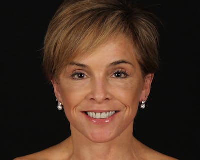 Face & Neck Lift Before & After Gallery - Patient 116095 - Image 2