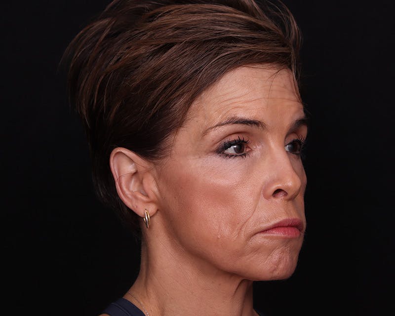 Face & Neck Lift Before & After Gallery - Patient 116095 - Image 3