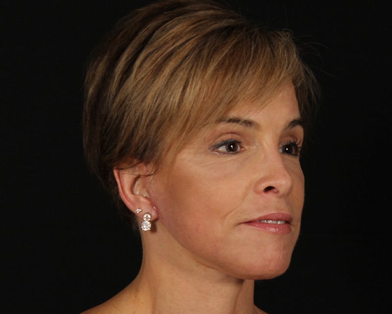 Face & Neck Lift Before & After Gallery - Patient 116095 - Image 4