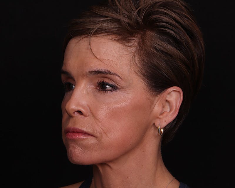 Face & Neck Lift Before & After Gallery - Patient 116095 - Image 5