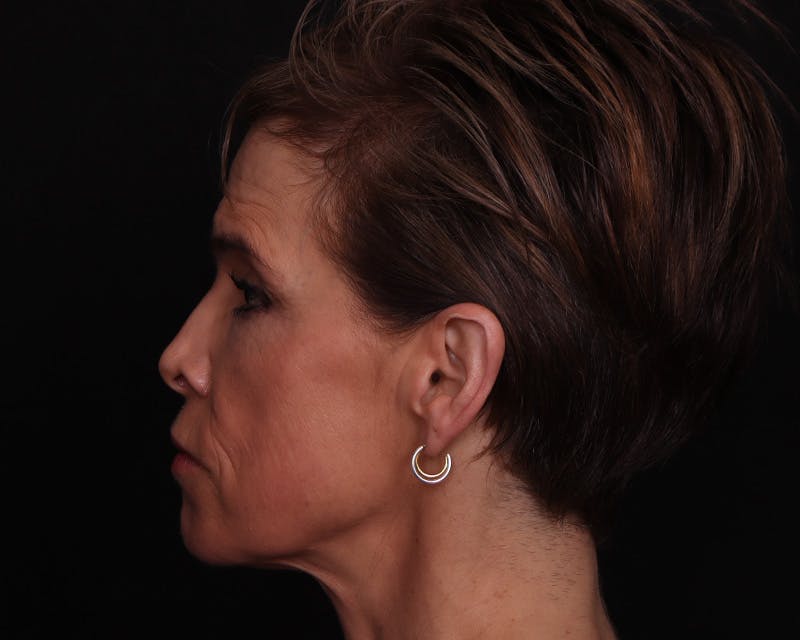 Face & Neck Lift Before & After Gallery - Patient 116095 - Image 7