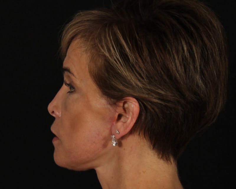 Face & Neck Lift Before & After Gallery - Patient 116095 - Image 8