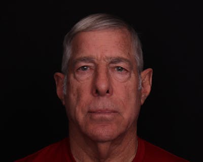 Face & Neck Lift Before & After Gallery - Patient 362321 - Image 1