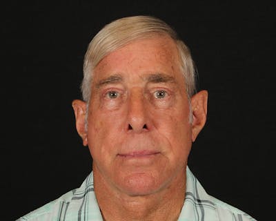 Face & Neck Lift Before & After Gallery - Patient 362321 - Image 2