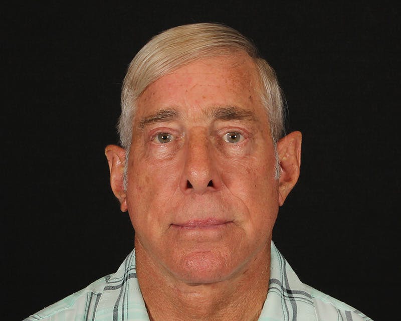 Face & Neck Lift Before & After Gallery - Patient 362321 - Image 2