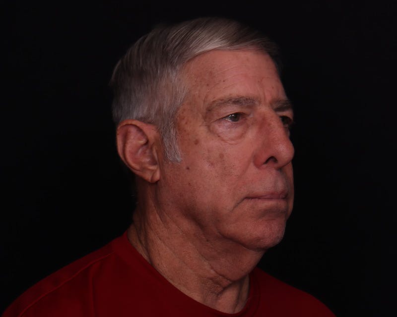 Face & Neck Lift Before & After Gallery - Patient 362321 - Image 3