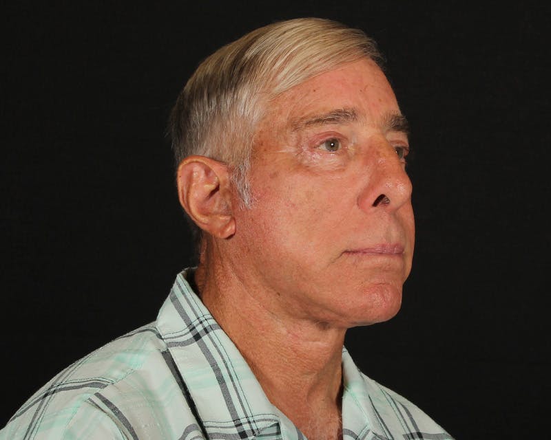 Face & Neck Lift Before & After Gallery - Patient 362321 - Image 4