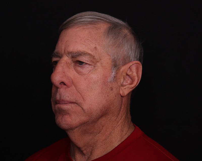 Face & Neck Lift Before & After Gallery - Patient 362321 - Image 5