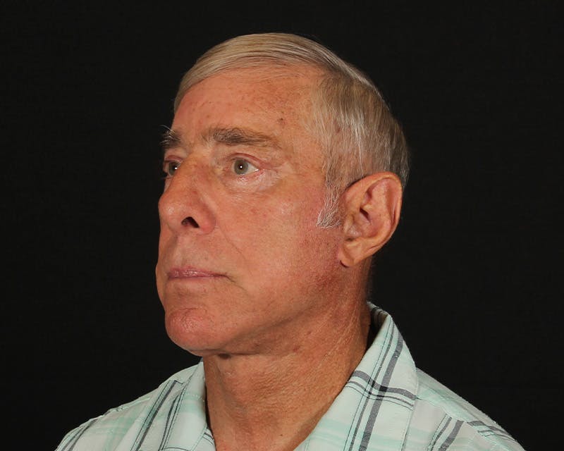 Face & Neck Lift Before & After Gallery - Patient 362321 - Image 6