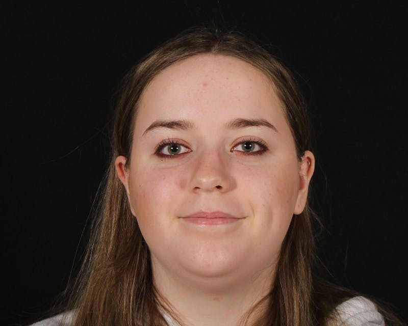 Rhinoplasty Female Before & After Gallery - Patient 264535 - Image 5