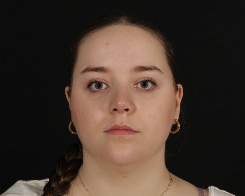 Rhinoplasty Female Before & After Gallery - Patient 264535 - Image 6