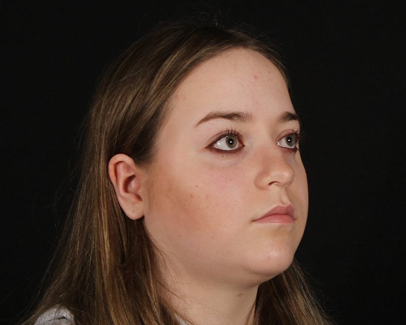 Rhinoplasty Female Before & After Gallery - Patient 264535 - Image 8