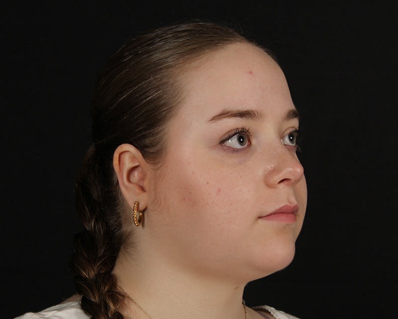 Rhinoplasty Female Before & After Gallery - Patient 264535 - Image 7