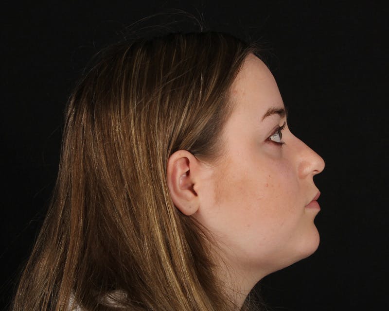 Rhinoplasty Female Before & After Gallery - Patient 264535 - Image 9