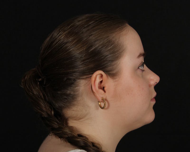 Rhinoplasty Female Before & After Gallery - Patient 264535 - Image 10