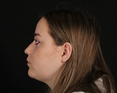 Rhinoplasty Female Before & After Gallery - Patient 264535 - Image 1