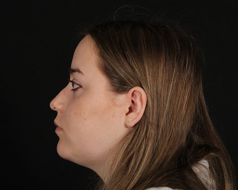 Rhinoplasty Female Before & After Gallery - Patient 264535 - Image 1