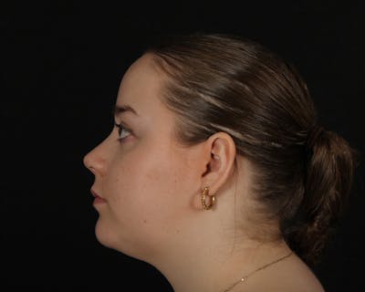 Rhinoplasty Female Before & After Gallery - Patient 264535 - Image 2