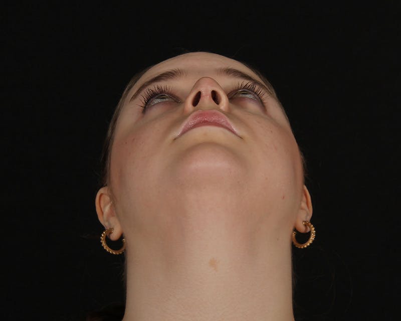 Rhinoplasty Female Before & After Gallery - Patient 264535 - Image 12