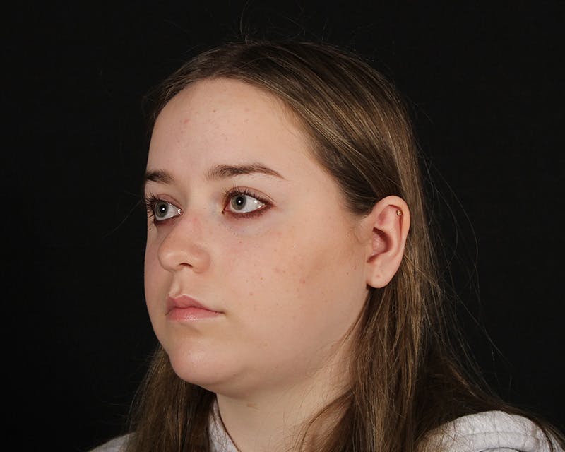 Rhinoplasty Female Before & After Gallery - Patient 264535 - Image 4
