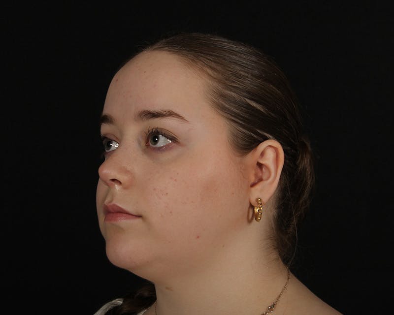 Rhinoplasty Female Before & After Gallery - Patient 264535 - Image 3