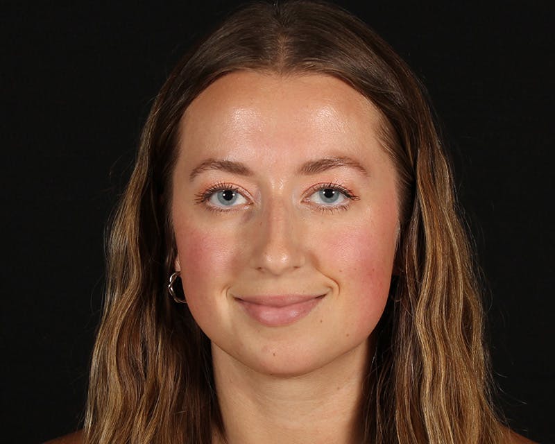 Rhinoplasty Female Before & After Gallery - Patient 276612 - Image 5