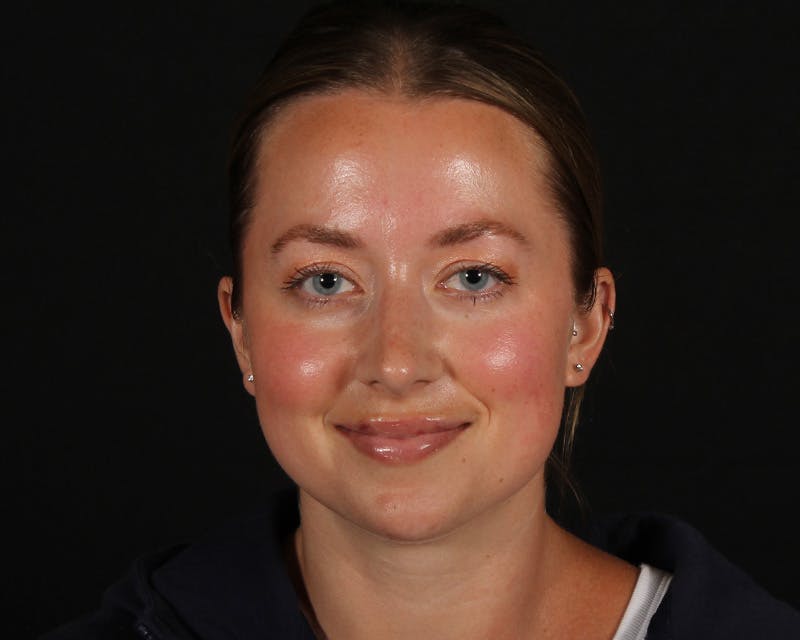 Rhinoplasty Female Before & After Gallery - Patient 276612 - Image 6
